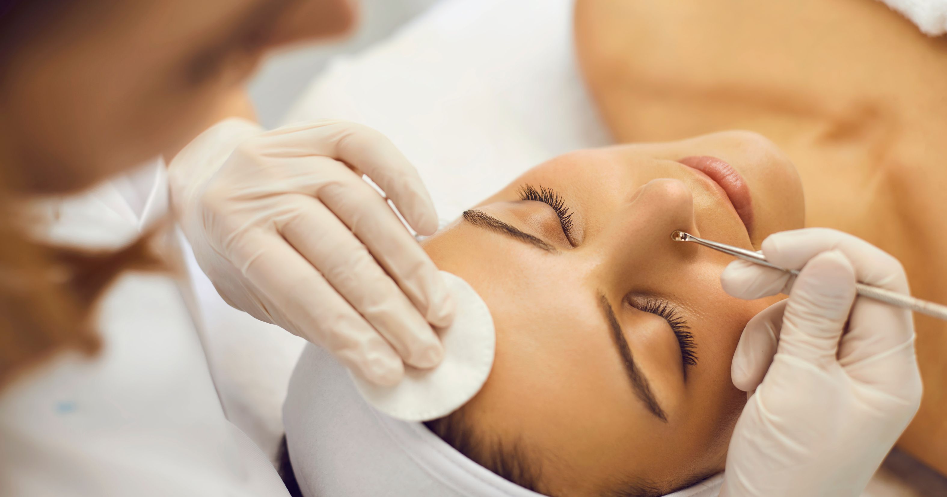 Blackhead Removal